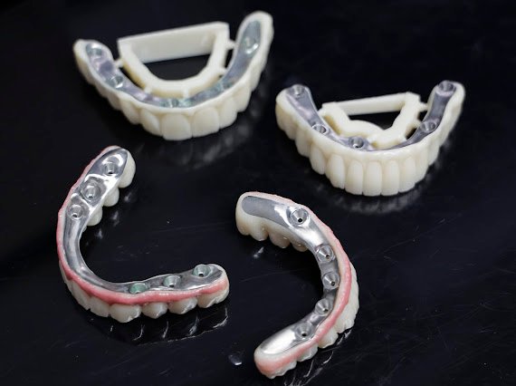 Implantatgetragene Brücken auf Titanbasis