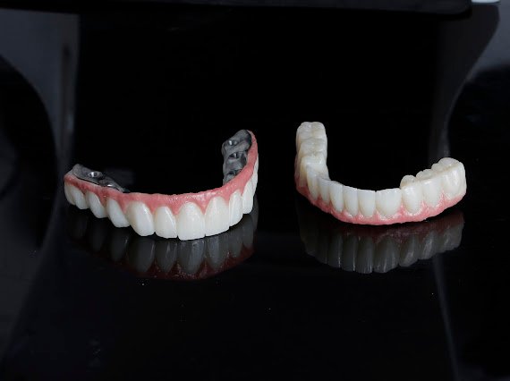 Implantatgetragene Prothese, Ober- und Unterkiefer