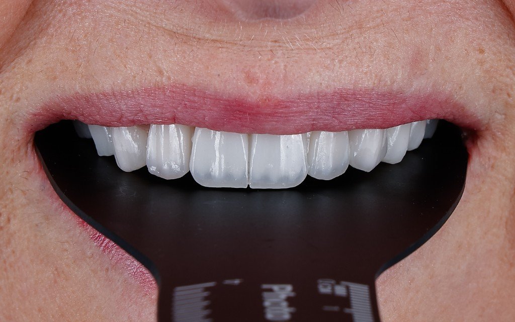 Veneers, Kontrolle unter Studiolicht