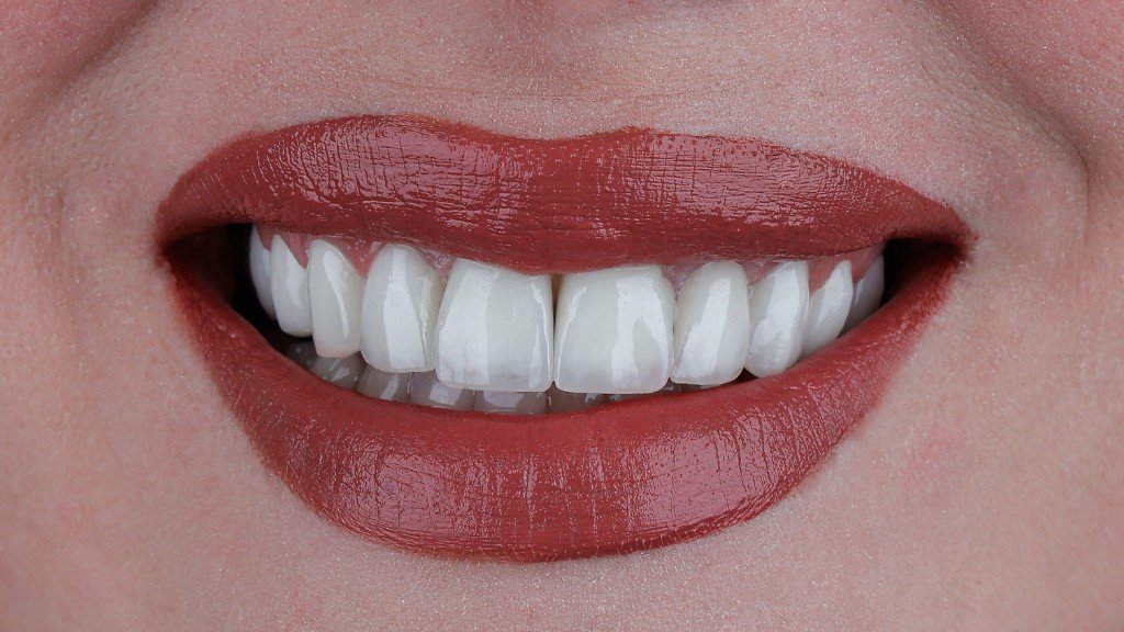 Natürlich wirkende Veneers, Frontzahnbereich